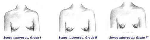 Grados de mamas tuberosas